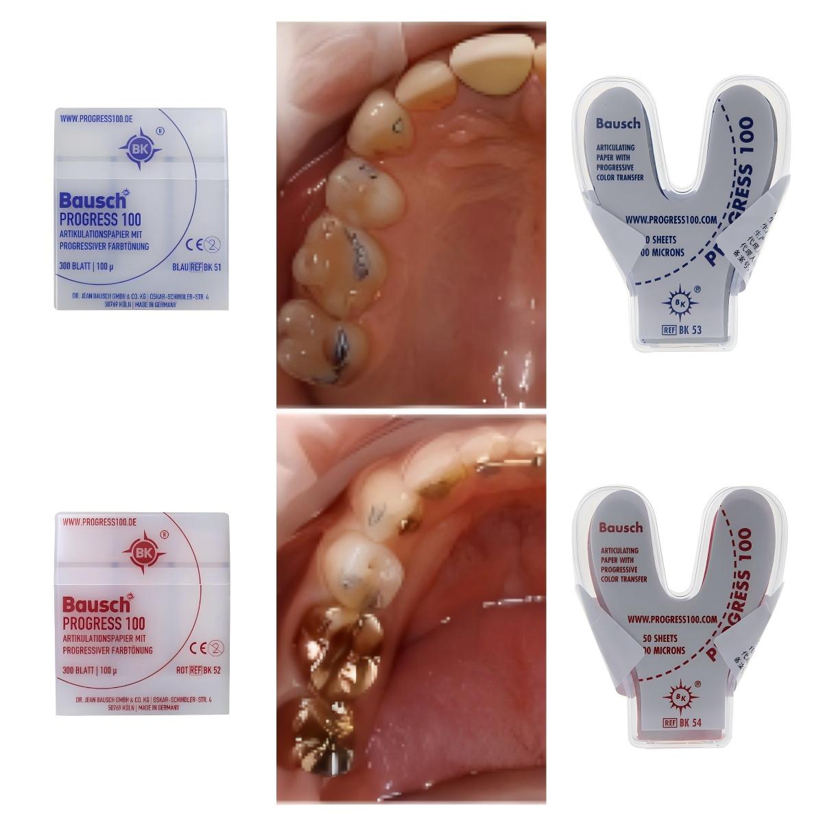 Bausch BK51 BK52 BK53 BK54 Den - Bite Indicator review and price